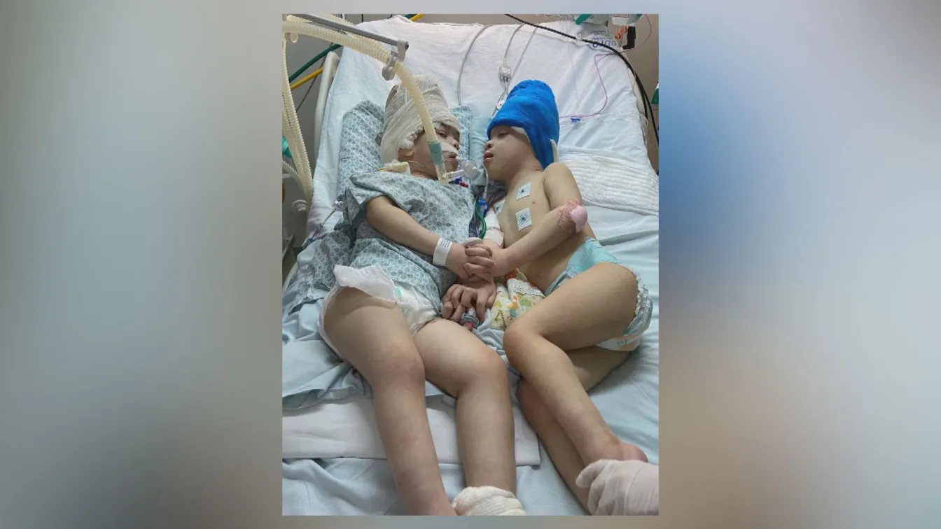 С дъх на живот: С помощта на виртуална реалност разделиха сиамски близнаци 