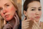 Розацея или акне: Как да ги различим и лекуваме