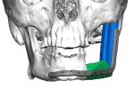 С прости усилия операции с 3D принтирани импланти могат да се правят навсякъде у нас