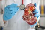 До 50% от хроничните бъбречни заболявания са недиагностицирани