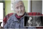 Историята на „вкамененото“ бебе: Възрастна жена разбира, че е била бременна 60 г. по-късно  