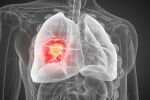 Прогресия при рак на белия дроб: Растежът на туморите определя лечението