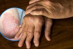7 начина да се погрижите за ставите през лятото с псориатичен артрит