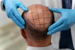 Косопад и присаждане на коса: Причини и рискове, които трябва да знаете