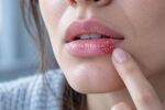 Херпес на устните, защо се появява стресницата и как да я овладеем