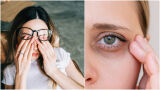 Тъмни кръгове под очите - как да ги заличим. Експертите разкриват (СНИМКИ)