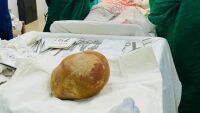 С теглото на новородено бебе и с размерите на щраусово яйце: Лекари извадиха 17-сантиметров камък от пикочния мехур на мъж (СНИМКИ)