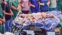 Коледно чудо: Сиамски близнаци се прибират у дома след успешна операция по разделяне 
