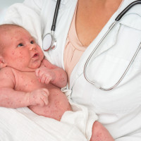 Морбили продължава да настъпва, нови случаи са регистрирани във Враца и Плевен