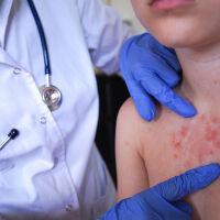 Продължават да се увеличават случаите на морбили в България – вече са 61