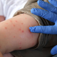 От началото на годината има 76 случая на морбили, за същия период на 2025 г. – само 1  