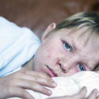 Увеличават се случаите на морбили в България – вече са 149