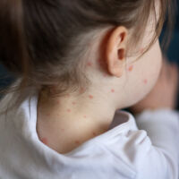 Заразените с морбили в България вече са над 190