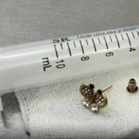 Оперираха 10-месечно бебе, погълнало обеца (ВИДЕО)