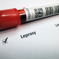 Потвърдиха случай на проказа в Хърватия за първи път от над 30 години