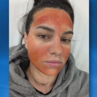 "Не мога да опиша болките": Млада жена е с изгаряния след процедура в салон за красота