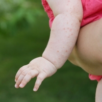 Три случая на морбили във Варна