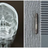 Спешна операция спаси зрението на млада жена с 10-милиметрова шнола в окото