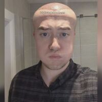 „Приличах на Мегаум, челото ми се поду, бях с насинени очи“: Мъж се подложи на интервенция с неочакван край 