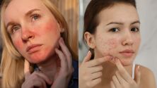 Розацея или акне: Как да ги различим и лекуваме