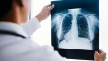 Изкуствен интелект помага на лекари да откриват белодробни заболявания
