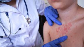 Продължават да се увеличават случаите на морбили – вече са 61