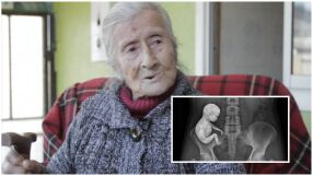 Историята на „вкамененото“ бебе: Възрастна жена разбира, че е била бременна 60 г. по-късно  