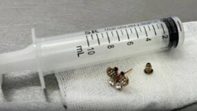 Оперираха 10-месечно бебе, погълнало обеца 