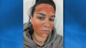 "Не мога да опиша болките": Млада жена е с изгаряния след процедура в салон за красота