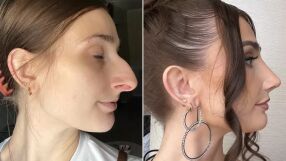 Тотална промяна! Жена харчи 11 хил. долара за операция на носа (СНИМКИ)