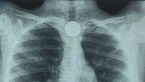 9-годишно дете погълна монета, която се заклещи в хранопровода ѝ (ВИДЕО)