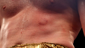 Отнеха лиценза на боксьора, който ухапа съперник (ВИДЕО)