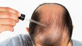 Експериментален серум може да възстанови косата след оплешивяване за 20 дни - ето как работи