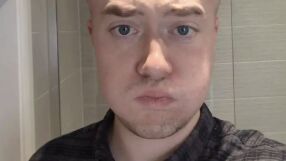 „Приличах на Мегаум, челото ми се поду, бях с насинени очи“: Мъж се подложи на интервенция с неочакван край 