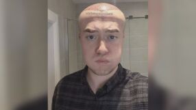 „Приличах на Мегаум, челото ми се поду, бях с насинени очи“: Мъж се подложи на интервенция с неочакван край 