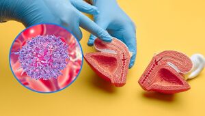 Снимка: Рак на пикочния мехур: Детски вирус може да провокира заболяването