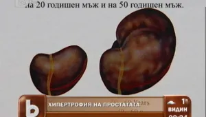 Хипертрофия на простатата