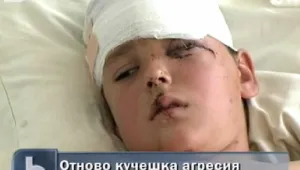 Питбул нахапа деветгодишно дете 