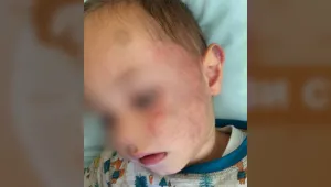 2-годишно дете беше взето от детската градина със синини