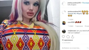 Българска студентка увеличи тройно устните си заради модата