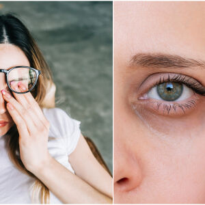 Край на уморения поглед: Експерти разкриват 4 вида тъмни кръгове и как да ги заличим (СНИМКИ)