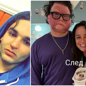 80% изгорял, 100% силен! Първа трансплантация на лице и ръце и открива любовта (СНИМКИ) 