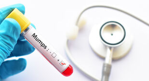 Нови случаи на заразени с морбили в областите Враца и Плевен