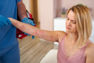 Защо хроничната уртикария е толкова трудна за диагностициране