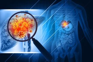 Какво представлява ракът на черния дроб