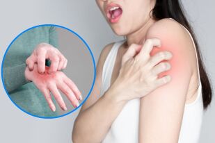 Какво представлява крастата и как се предава?