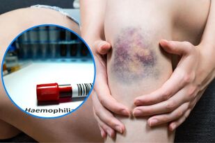 5 ключови симптома на хемофилия, за които да внимавате