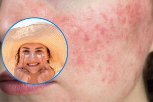 5 начина как да се справим с розацеята през пролетта