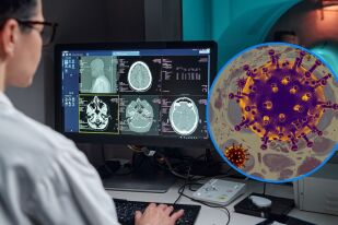 Постковид синдромът променя мозъка и води до когнитивен спад