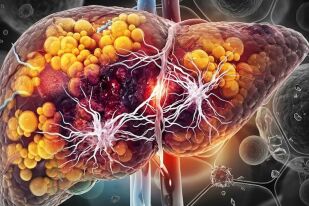 Oбратимо ли е възпалението на омазнен черен дроб